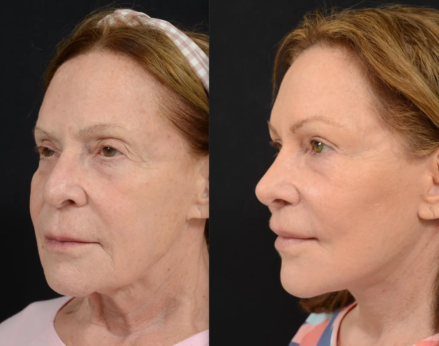 Facial Rejuvenation with Rhinoplasty
