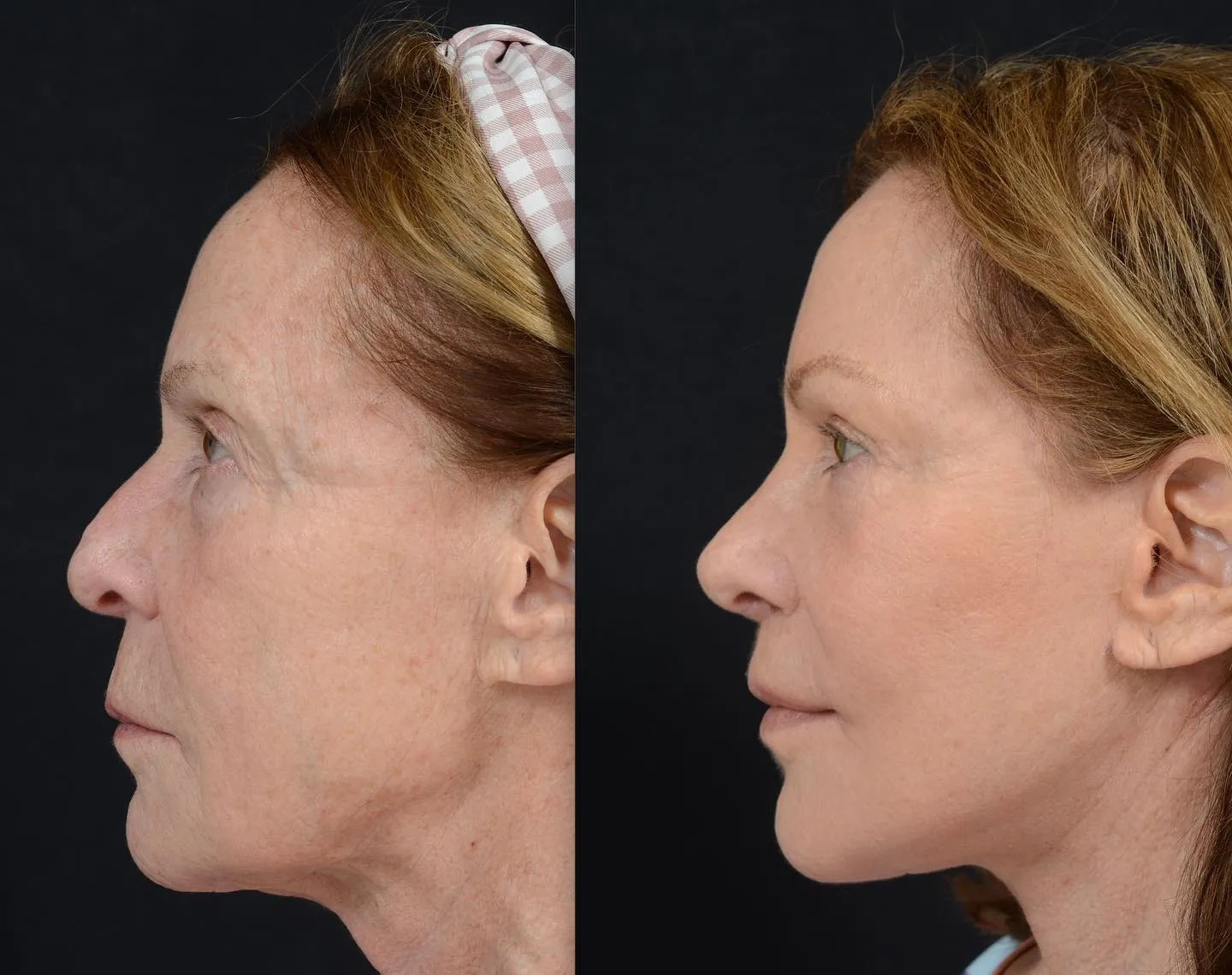Facial Rejuvenation with Rhinoplasty