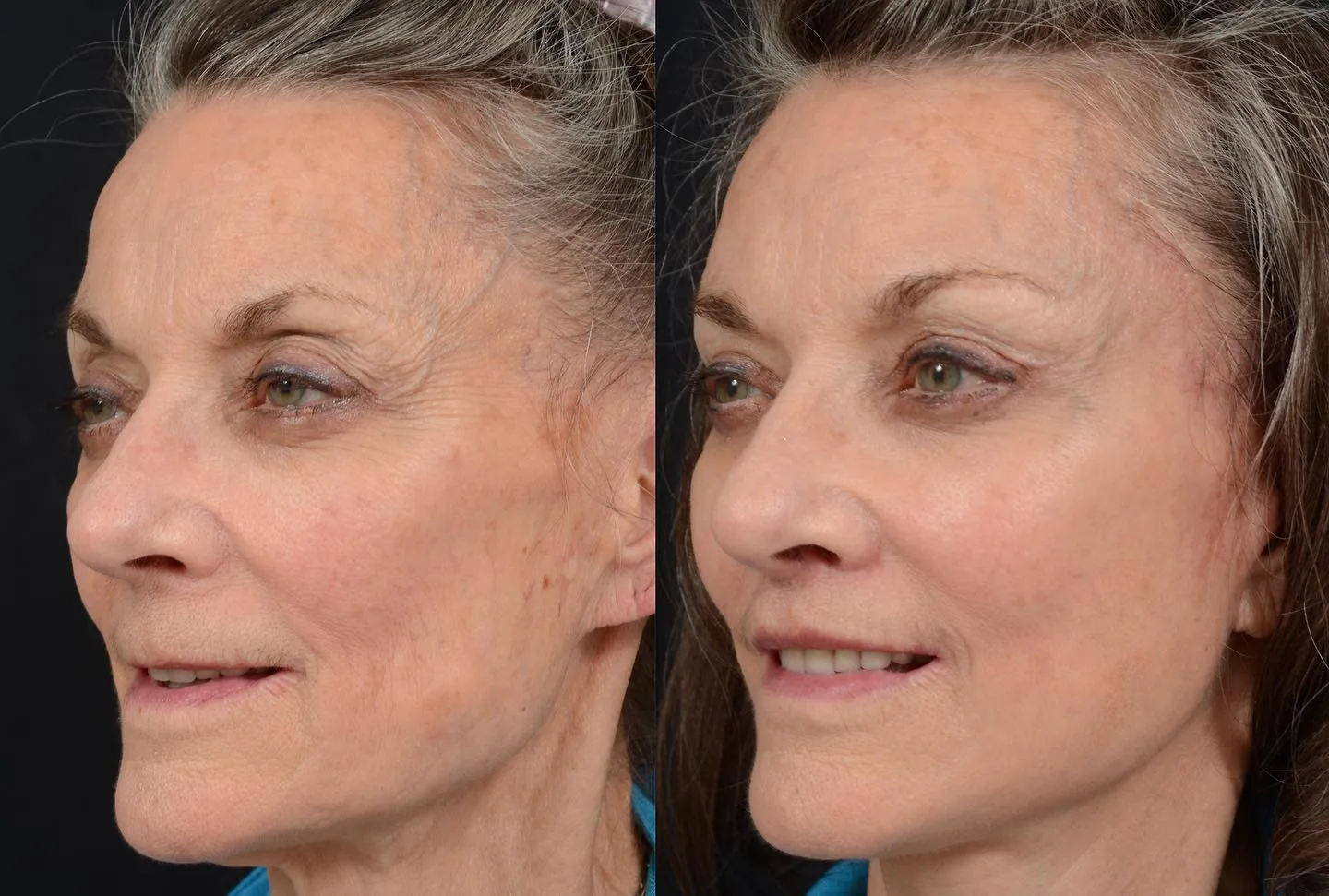 Facial Rejuvenation with Lip Lift