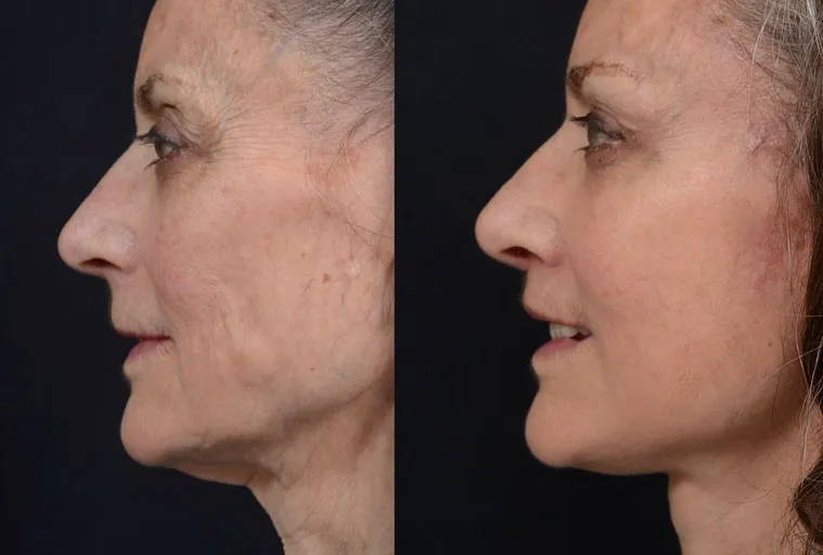 Facial Rejuvenation with Lip Lift