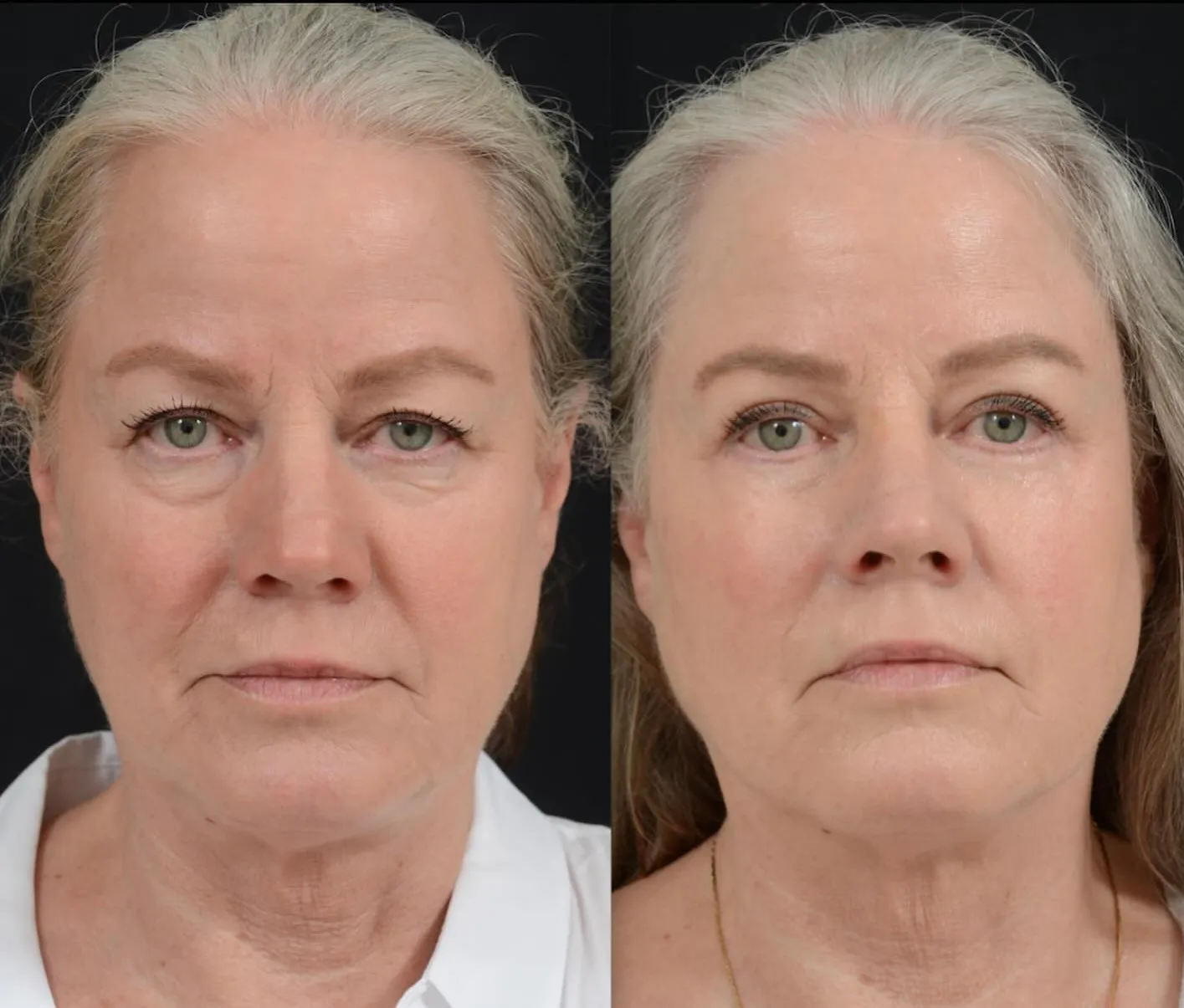 Blepharoplasty & Midface Lift