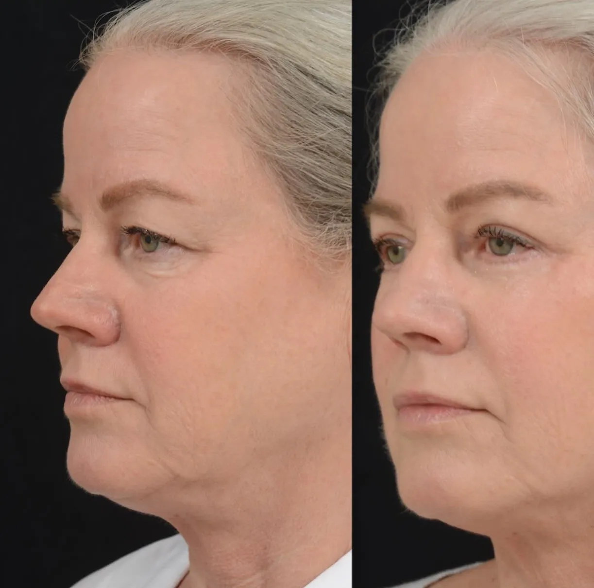 Blepharoplasty & Midface Lift