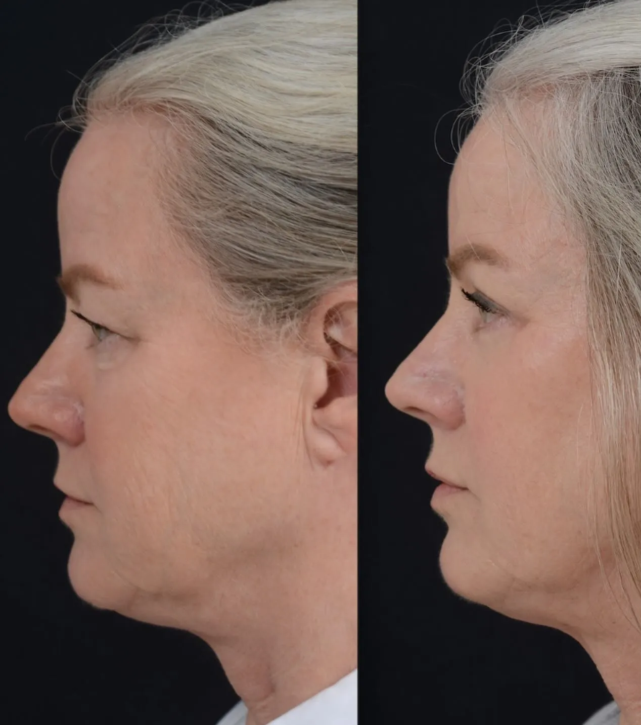 Blepharoplasty & Midface Lift