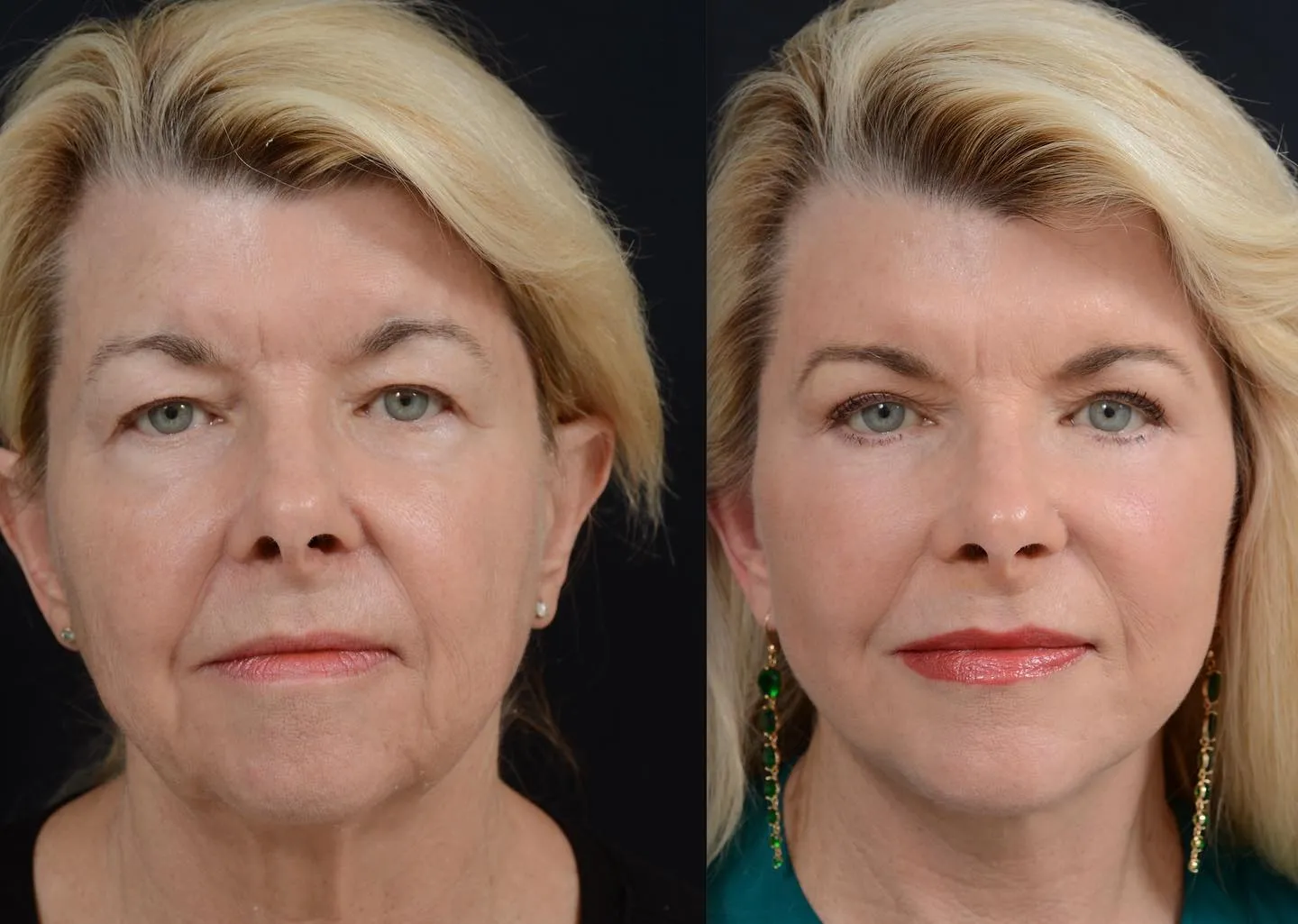 Facelift & Eyelid Surgery