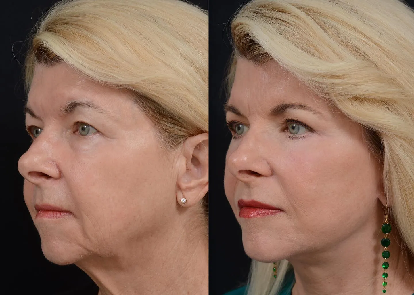 Facelift & Eyelid Surgery