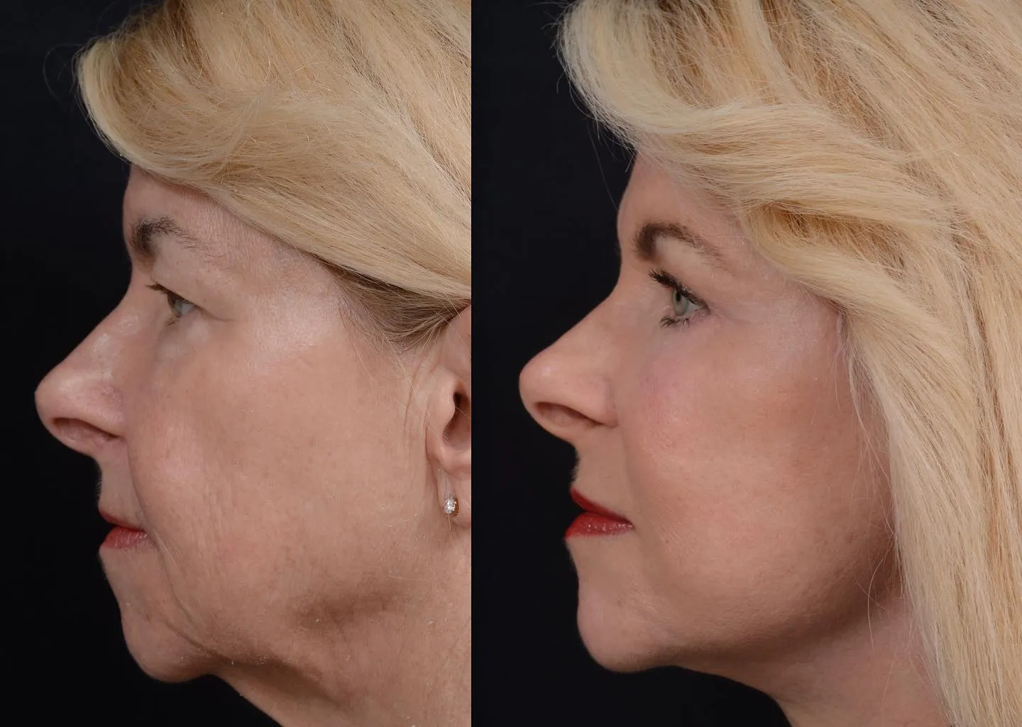 Facelift & Eyelid Surgery