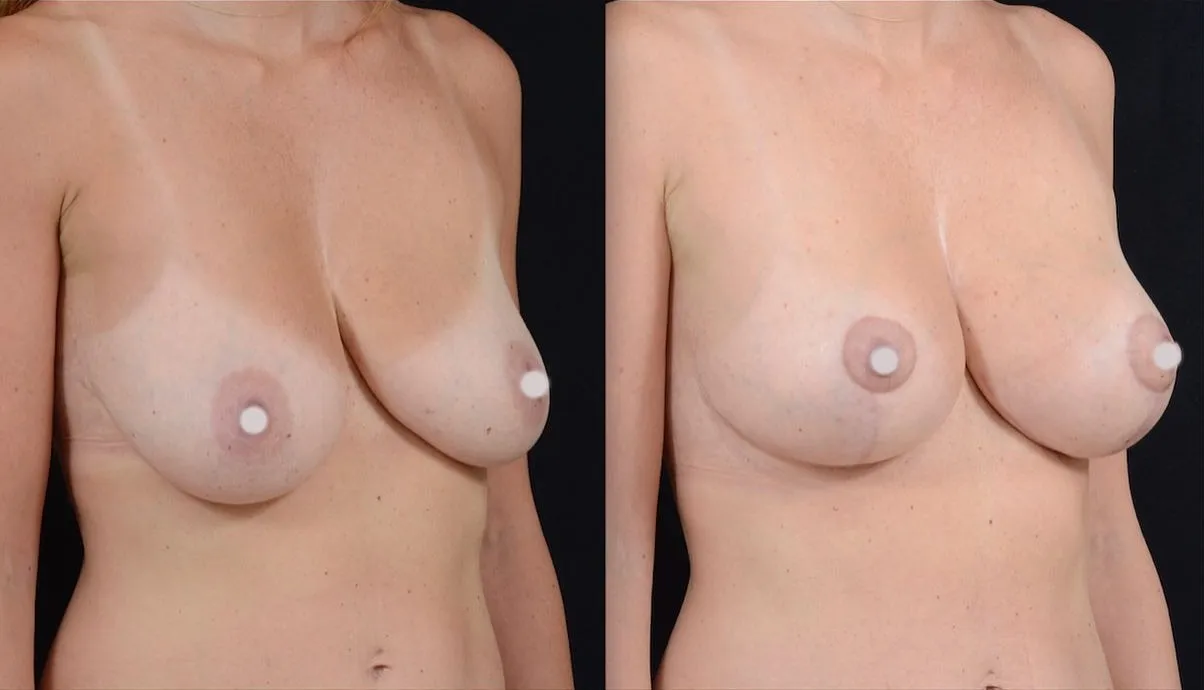Breast Uplift
