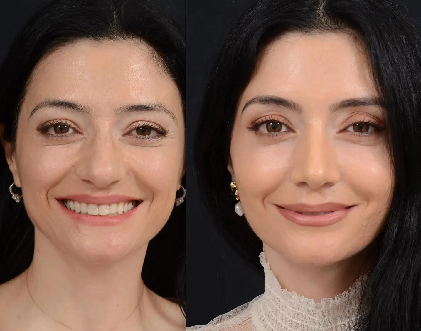 Finesse Rhinoplasty