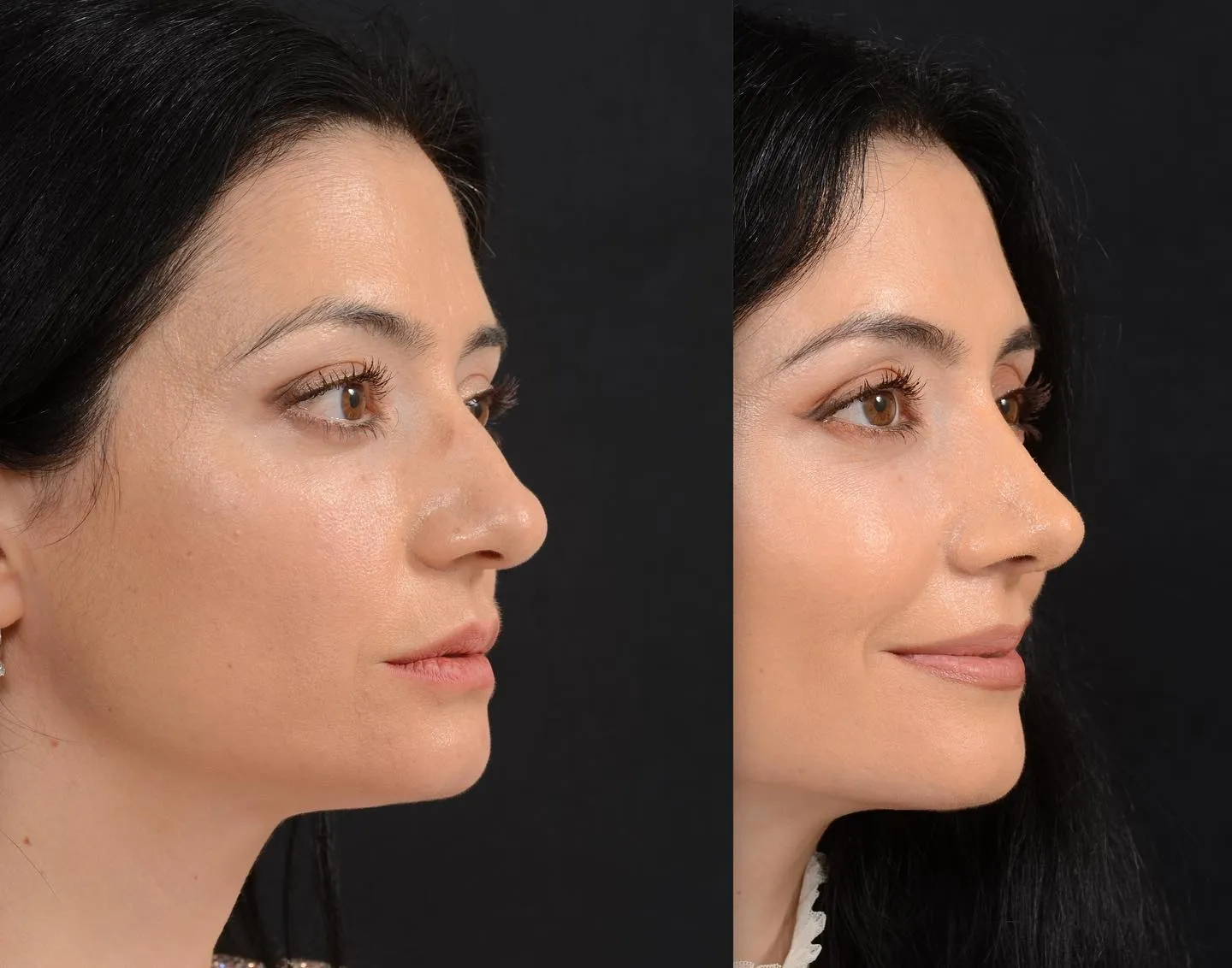 Finesse Rhinoplasty