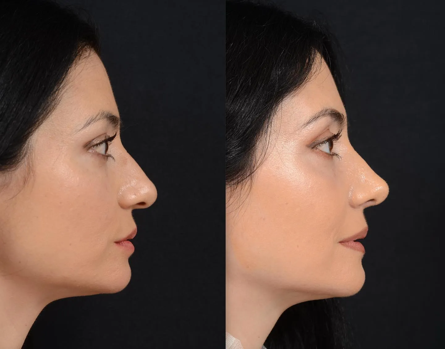 Finesse Rhinoplasty