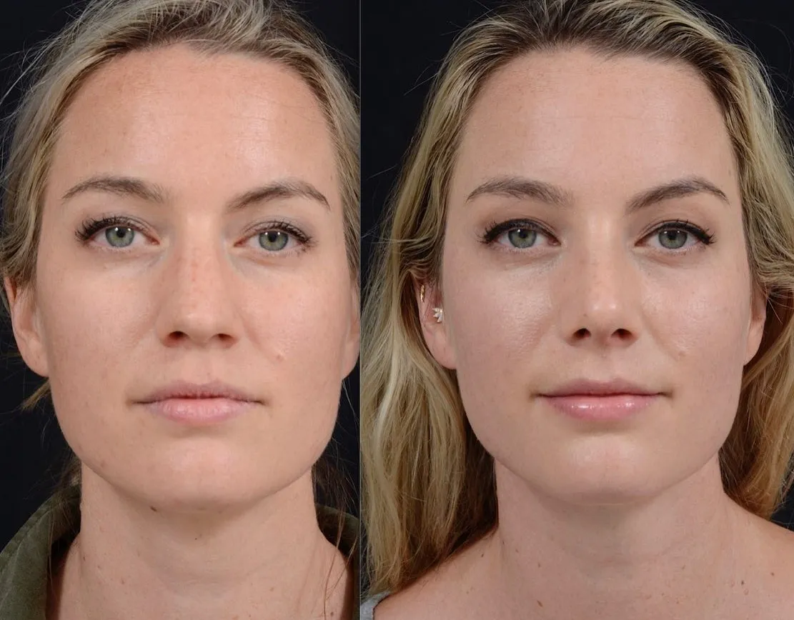 Preservation Rhinoplasty