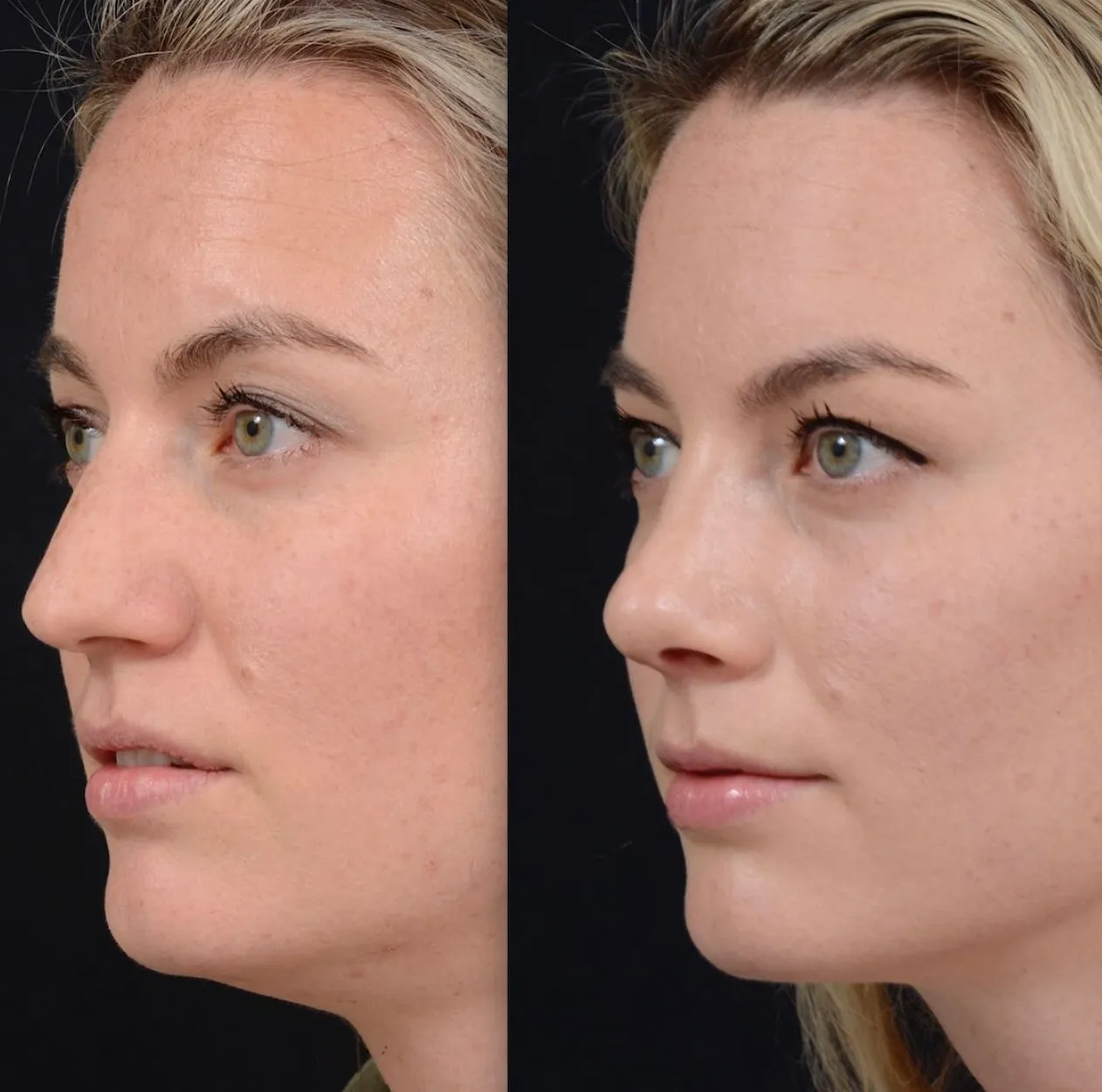 Preservation Rhinoplasty