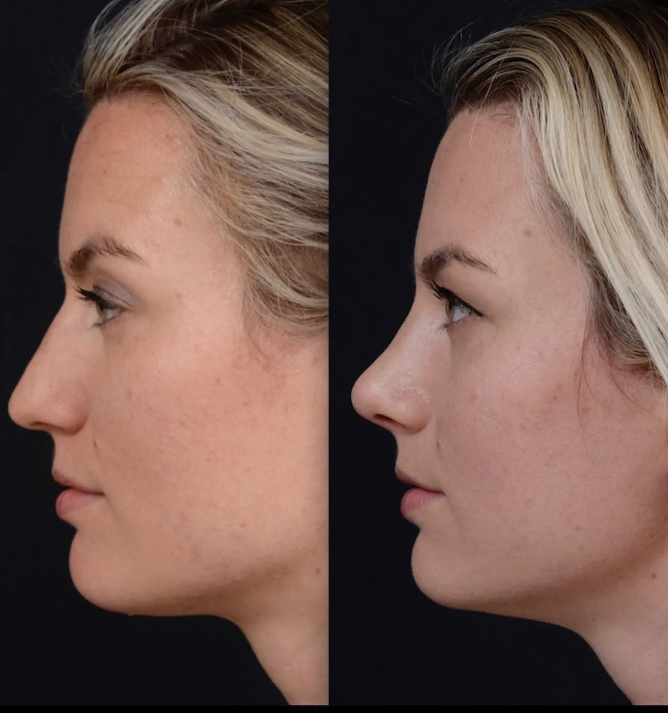 Preservation Rhinoplasty