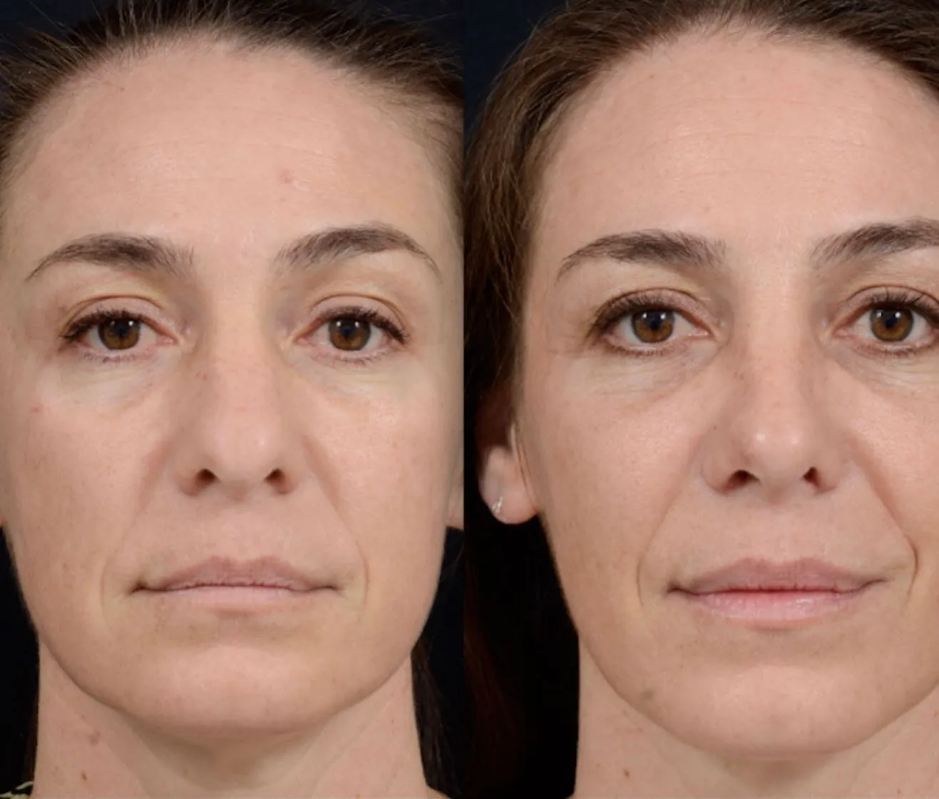 Minimal Rhinoplasty