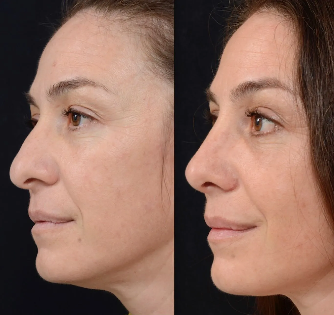 Minimal Rhinoplasty