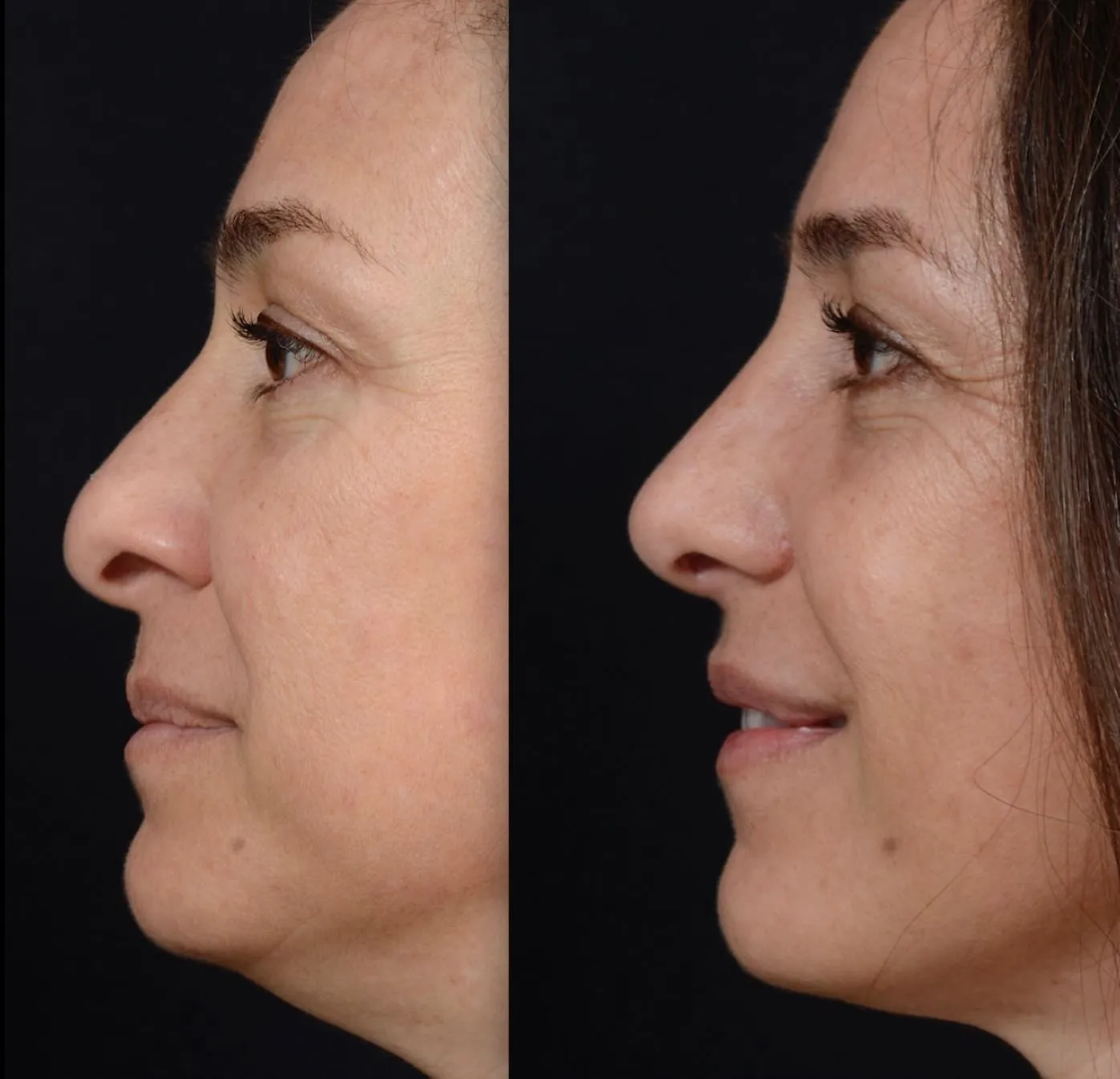Minimal Rhinoplasty