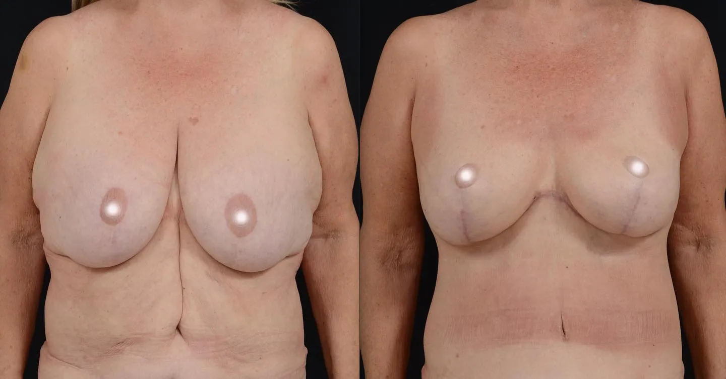Upper Body & Secondary Breast Lift