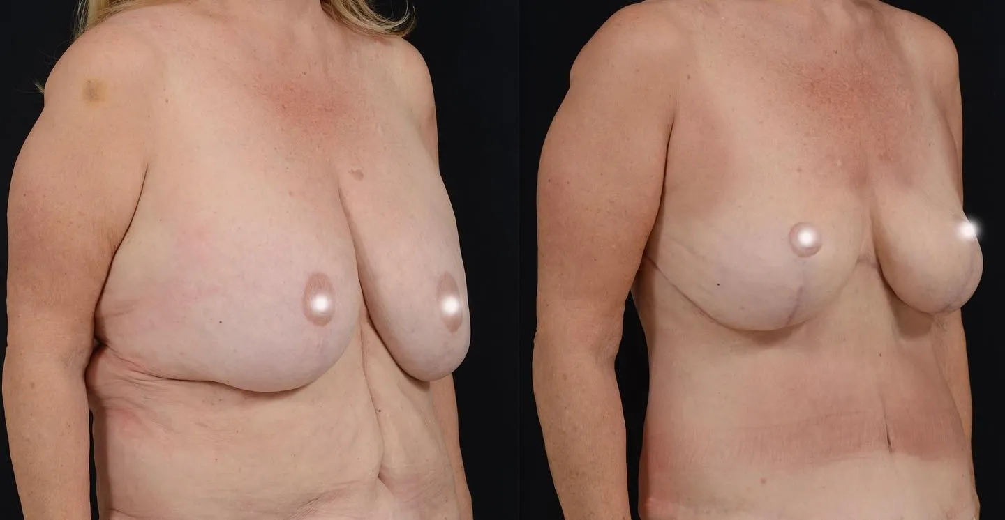 Upper Body & Secondary Breast Lift