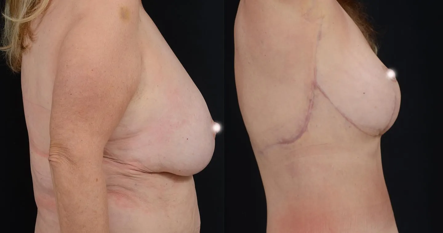 Upper Body & Secondary Breast Lift