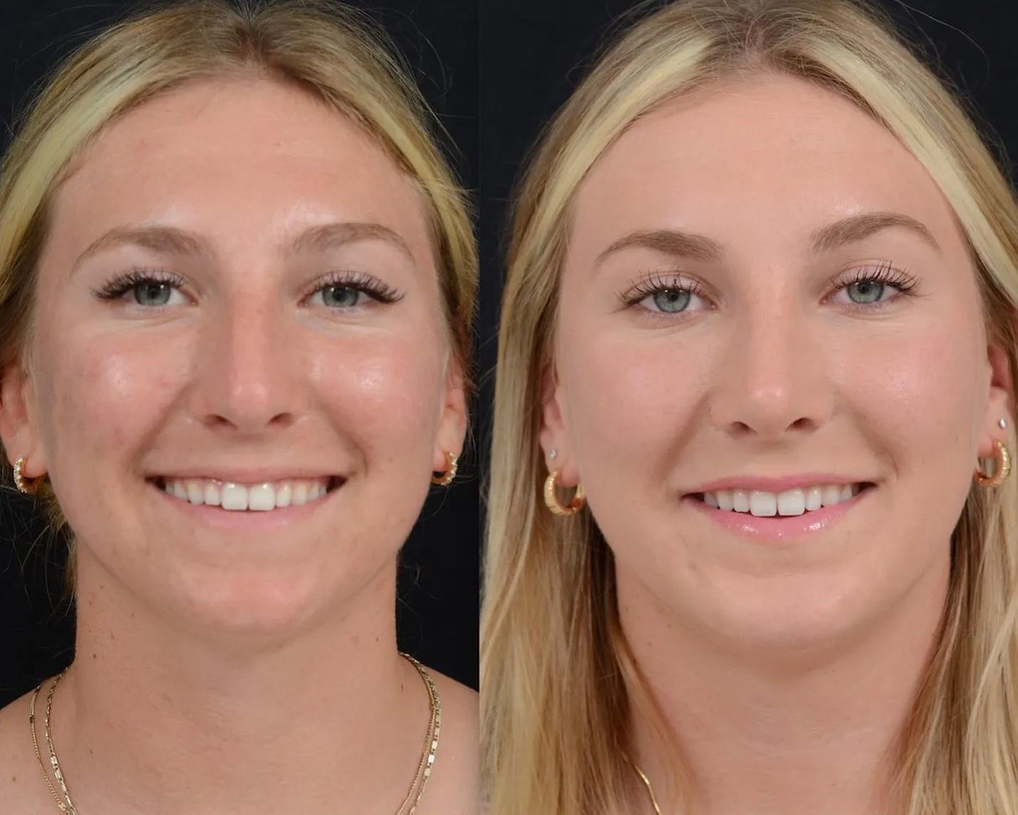 Rhinoplasty & Chin Implant