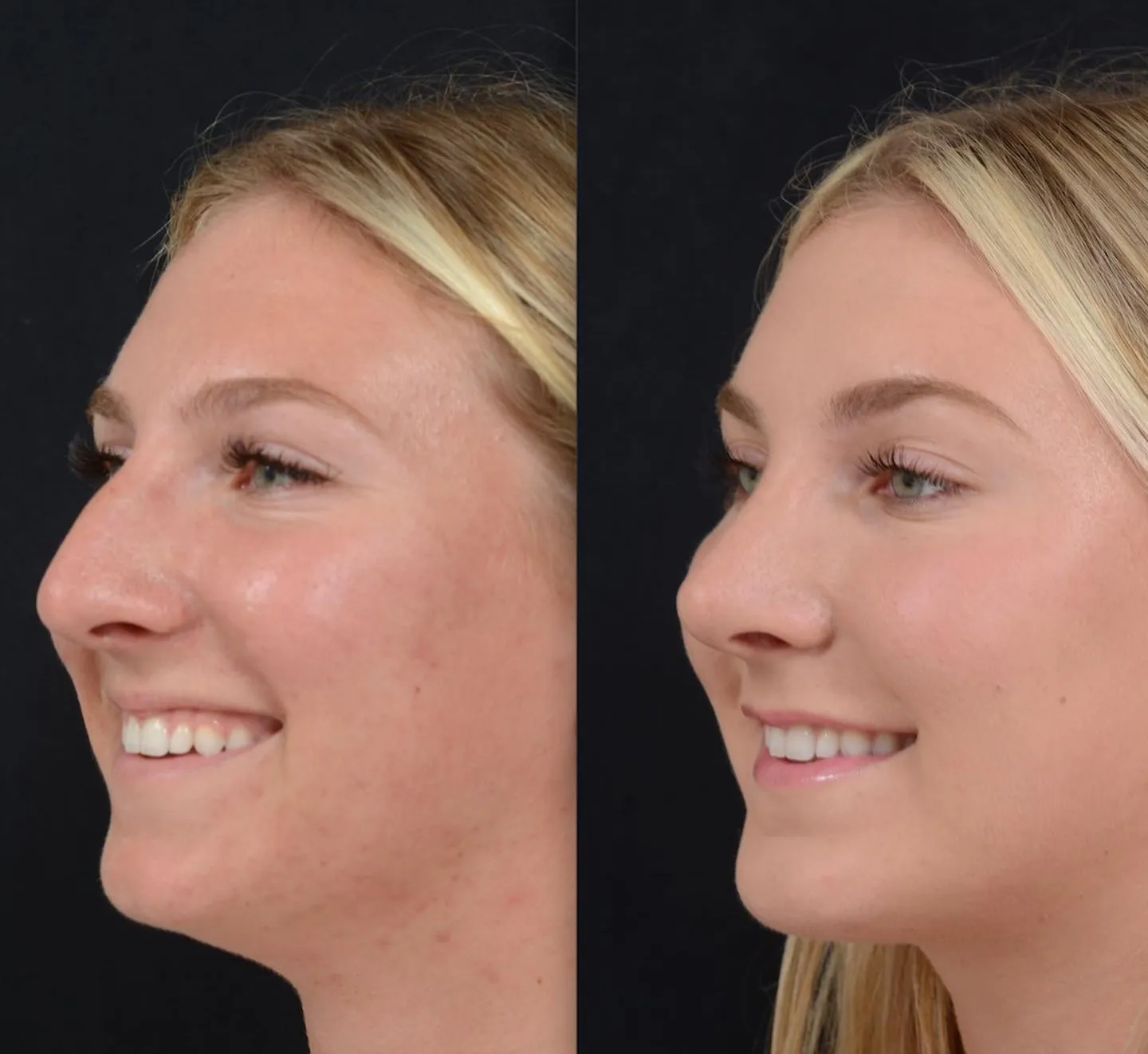 Rhinoplasty & Chin Implant