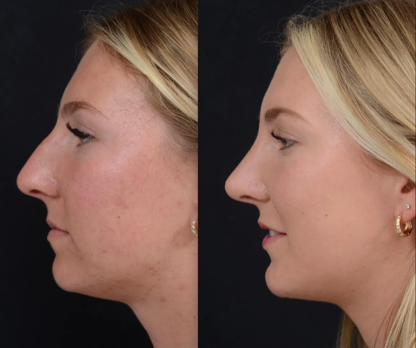 Rhinoplasty & Chin Implant