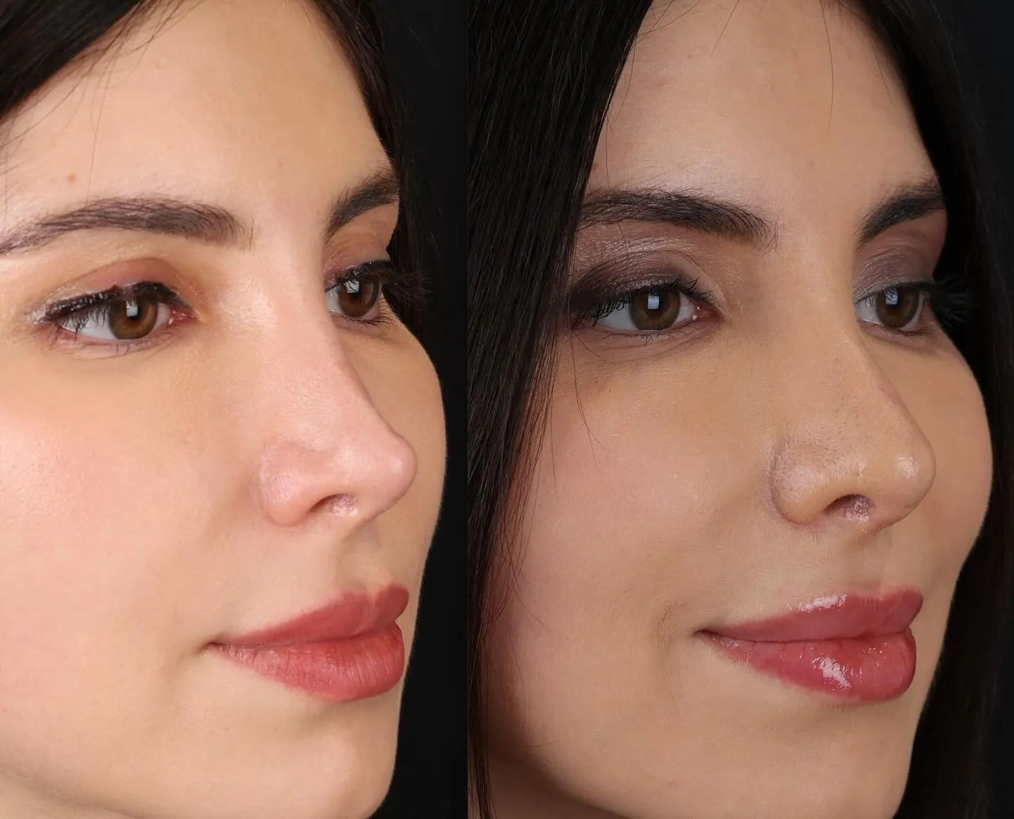 Revision Rhinoplasty