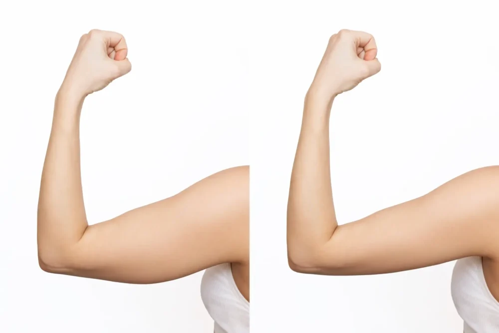 Arm Lift John Shamoun Plastic Surgeon Cosmetic Surgery Face Newport Beach CA Arm Lift Results 2