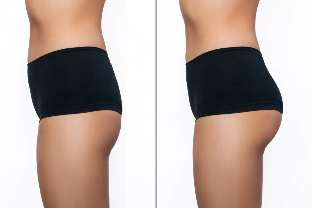 Brazilian Butt Lift John Shamoun Plastic Surgeon Cosmetic Surgery Face Newport Beach CA Brazilian Butt Lift Results
