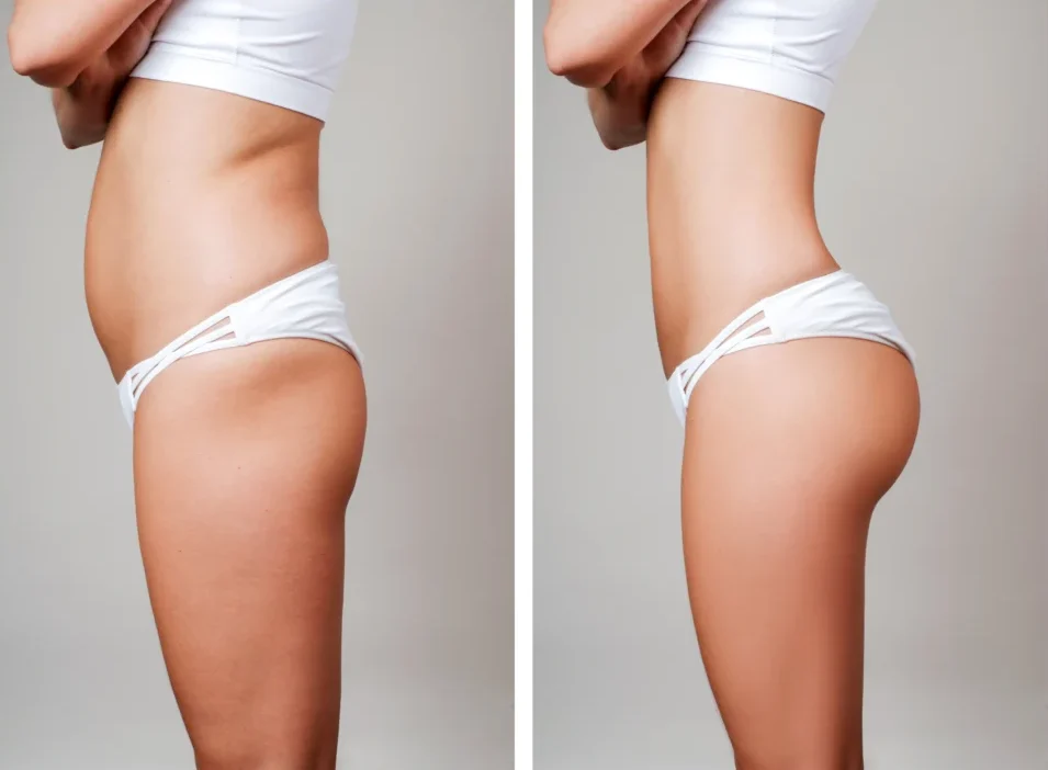 Fat Transfer John Shamoun Plastic Surgeon Cosmetic Surgery Face Newport Beach CA Fat Transfer Results