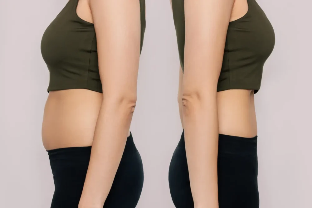 Liposuction John Shamoun Plastic Surgeon Cosmetic Surgery Face Newport Beach CA Liposuction Results