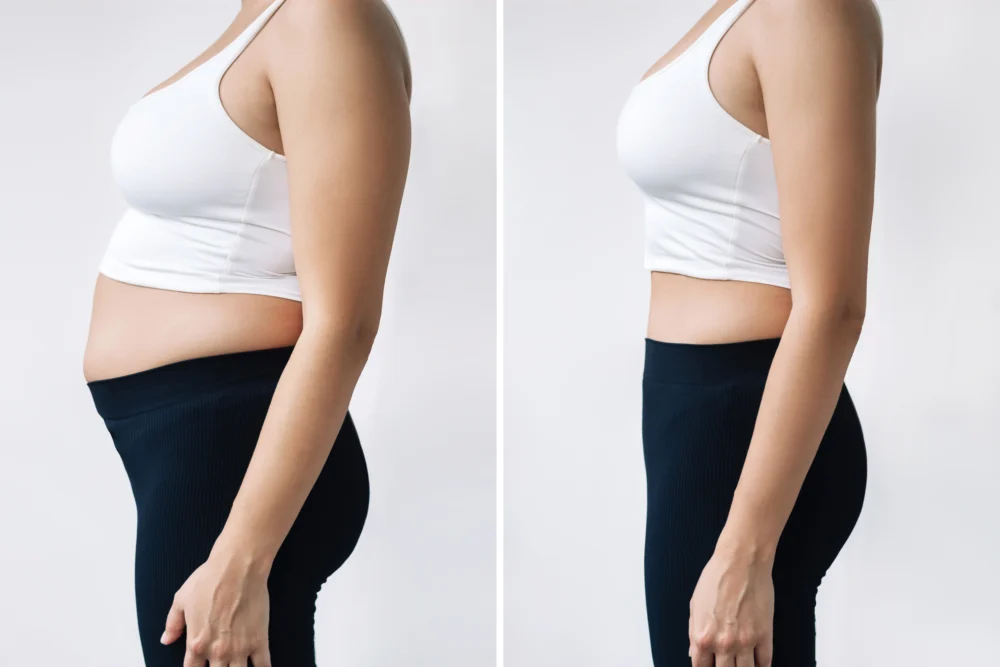 Mommy Makeover John Shamoun Plastic Surgeon Cosmetic Surgery Face Newport Beach CA Body Results