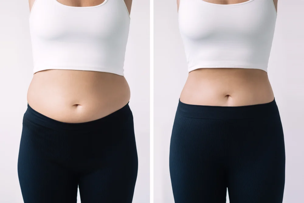 Tummy Tuck John Shamoun Plastic Surgeon Cosmetic Surgery Face Newport Beach CA Tummy Tuck Results