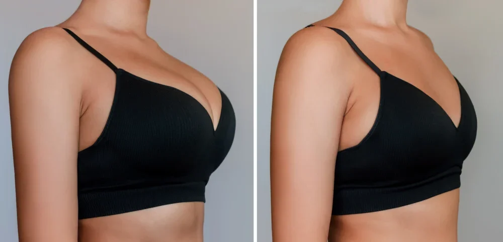 Breast Reduction Dr. John Shamoun – Newport Beach Plastic and Cosmetic Surgeon California Results Breast
